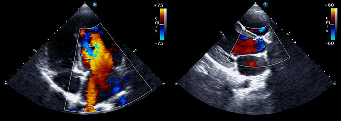 Ecocardiograma con Dobutamina